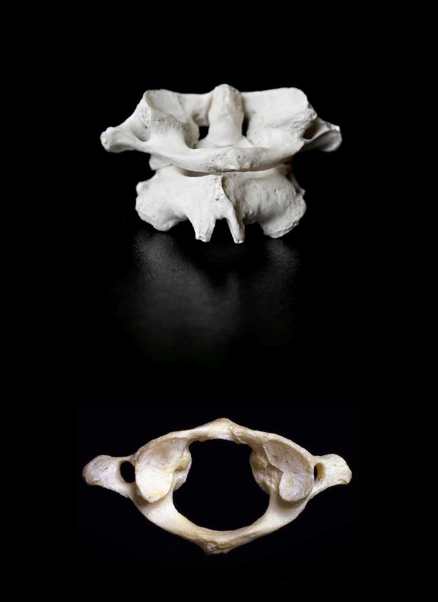 Upper Cervical refers to the first two bones in the neck C1 and C2 the Atlas